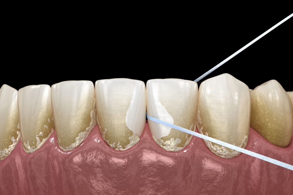 Dental plaque is a thin layer of sticky substance, mostly formed by a mixture of saliva, bacteria and other microorganisms, like fungi and it deposits on the gum line, between teeth and also on their front surface as well as behind them.