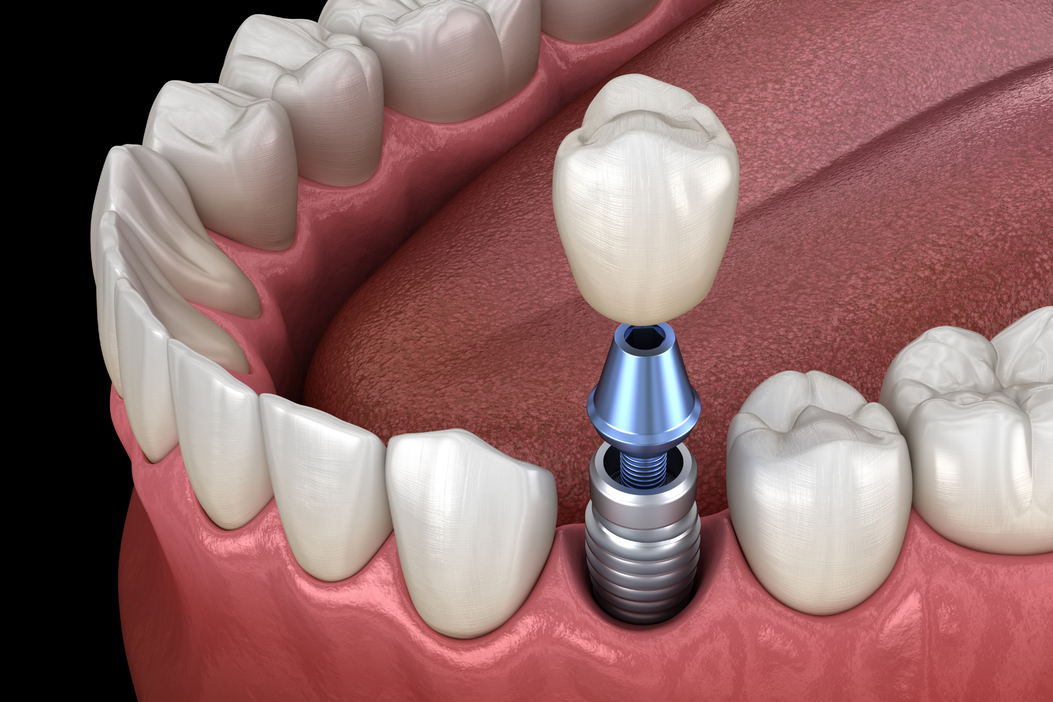Dental crown on implant