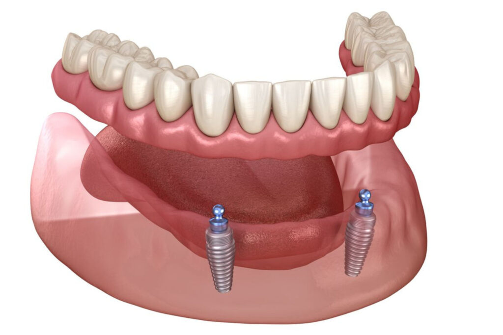 Locator overdenture on 2 Implants