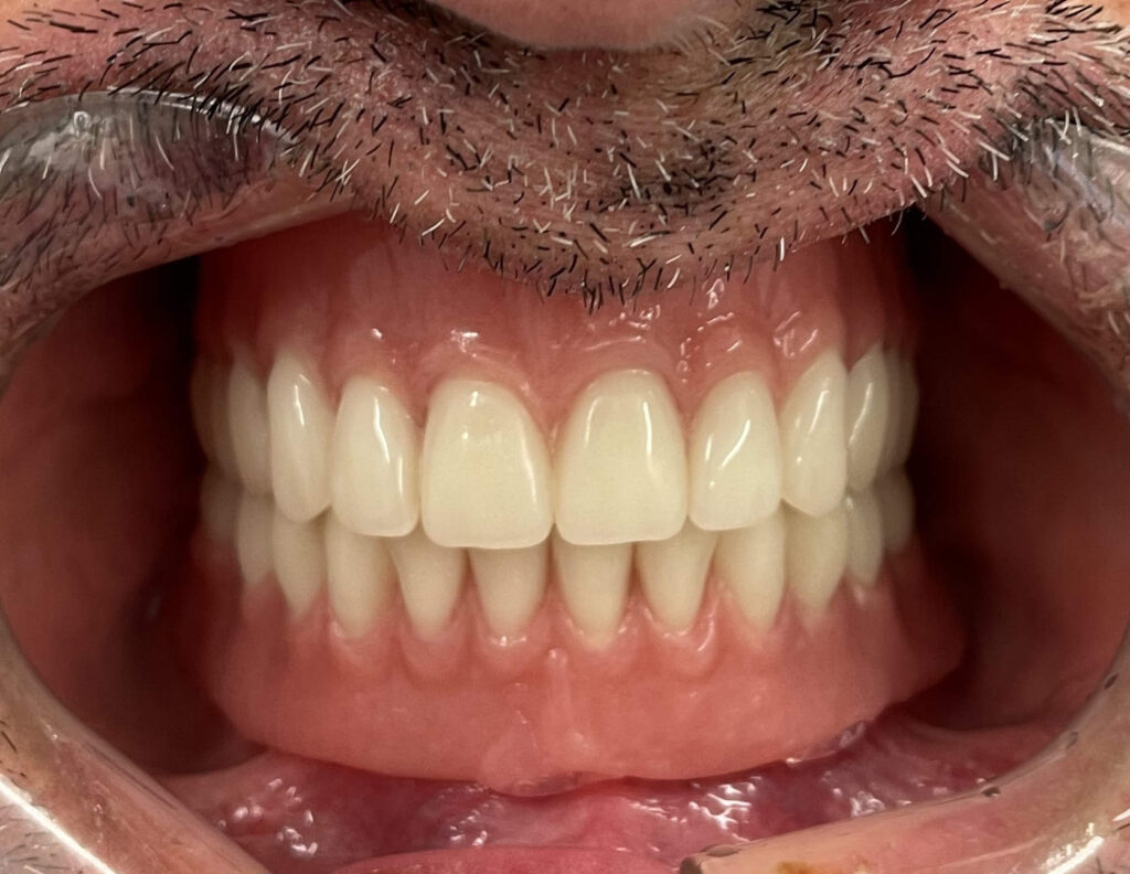 Locator overdenture on 4 Implants